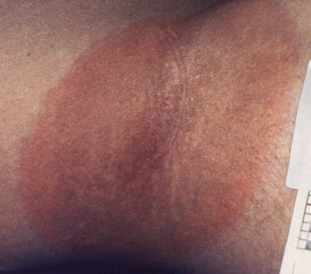 This image shows a rash shaped like a bull’s eye that sometimes appears at the site of a tick bite.