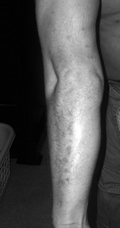 A person's arm with small, red spots.