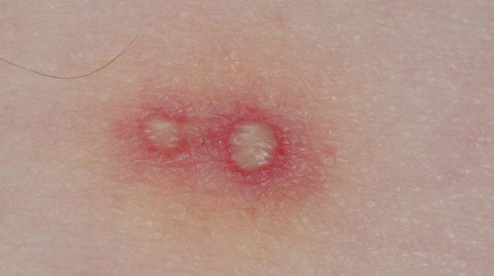 Two raised white pustules on skin due to a fire ant sting.