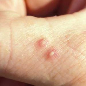 Two fire ant stings with raised white pustules.